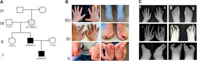 Variable clinical presentation of split hand/foot malformation syndrome in a family with microduplication of 10q24.32: a case report